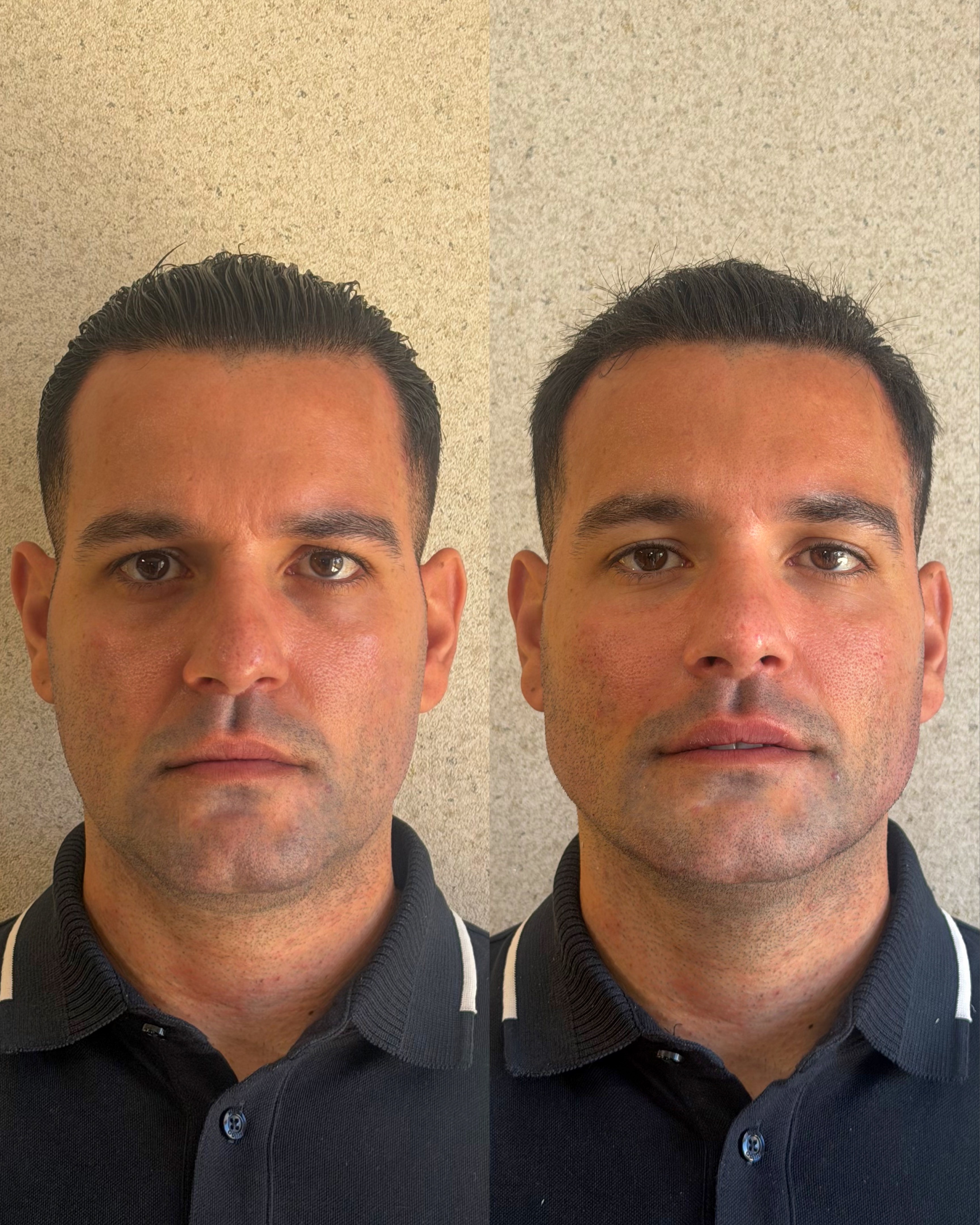 Resultado de Harmonização Facial 1