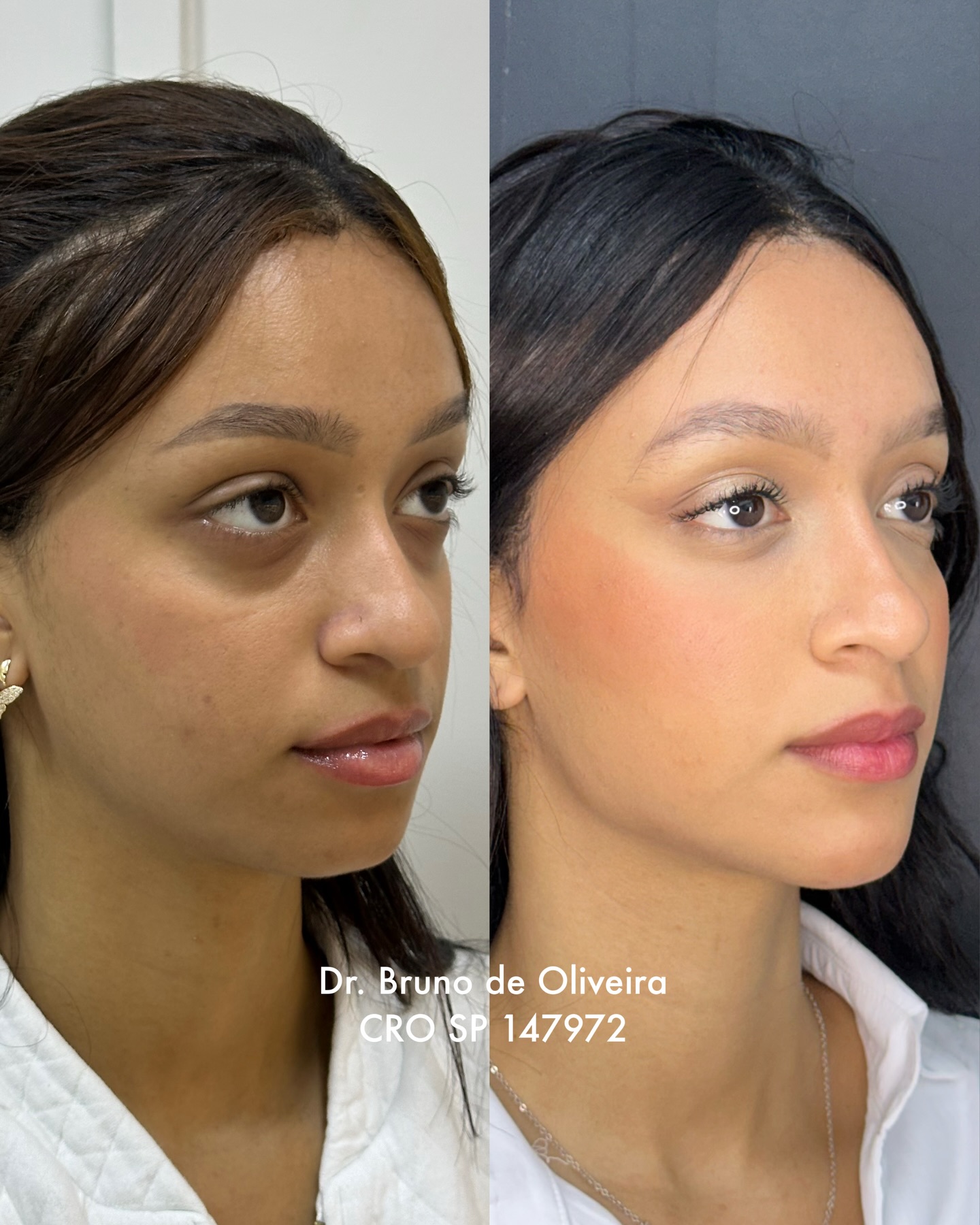 Resultado de Harmonização Facial 3