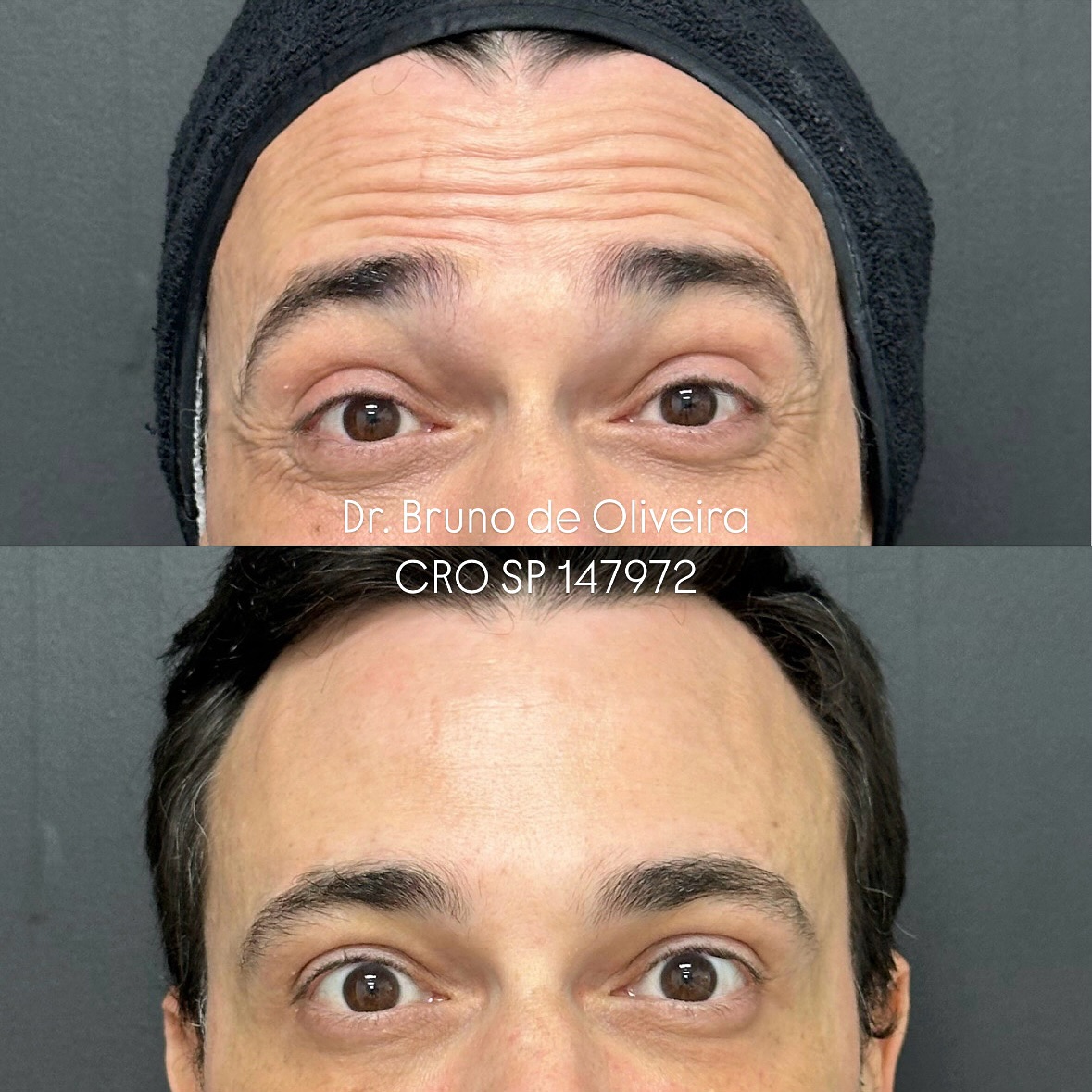 Resultado de Harmonização Facial 4