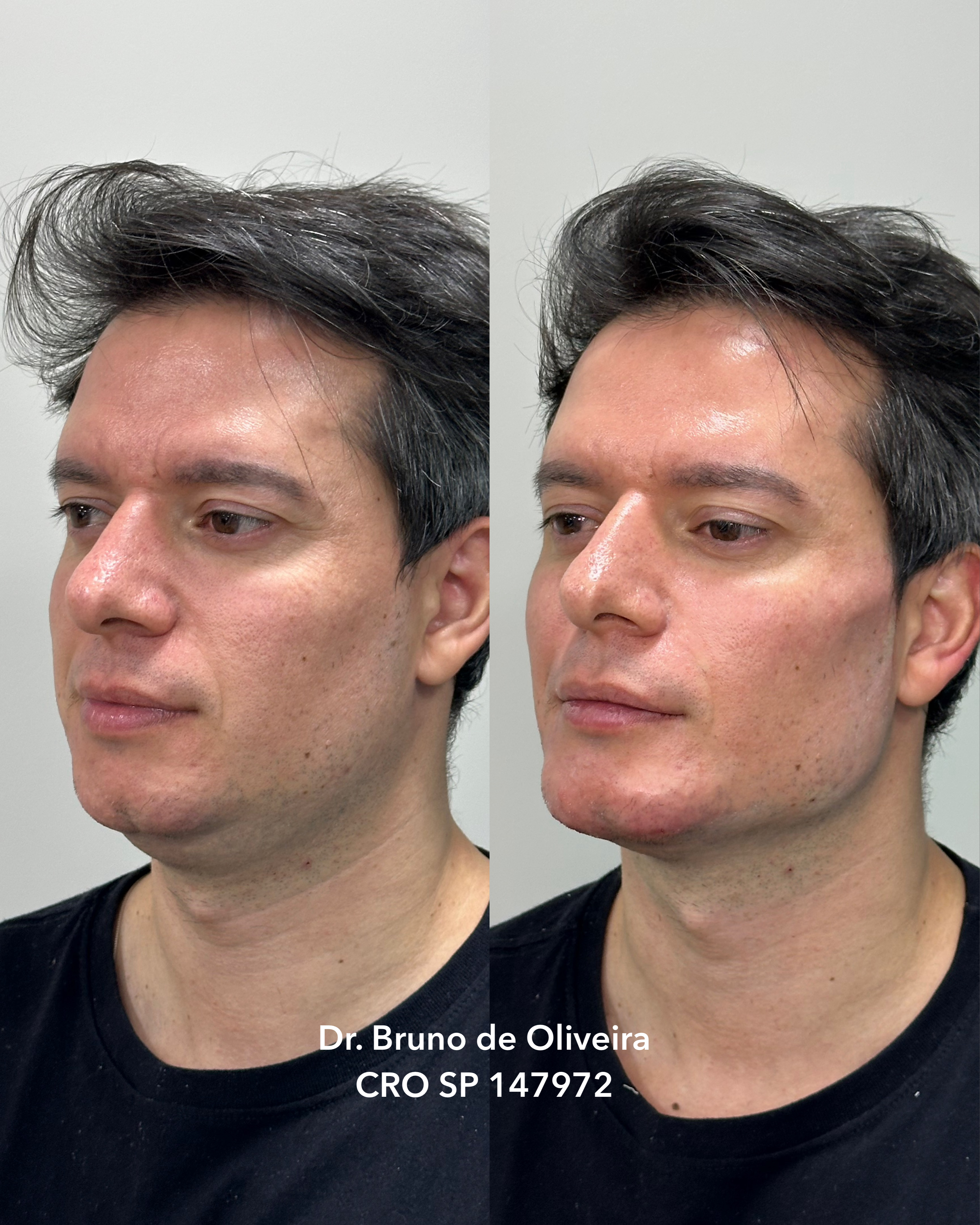 Resultado de Harmonização Facial 2